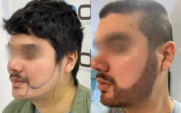 Le croste sono cadute 10 giorni dopo il trapianto di barba.