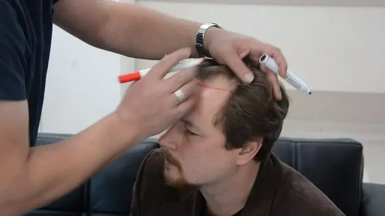 Gestaltung des Haaransatzes vor der Haartransplantatio