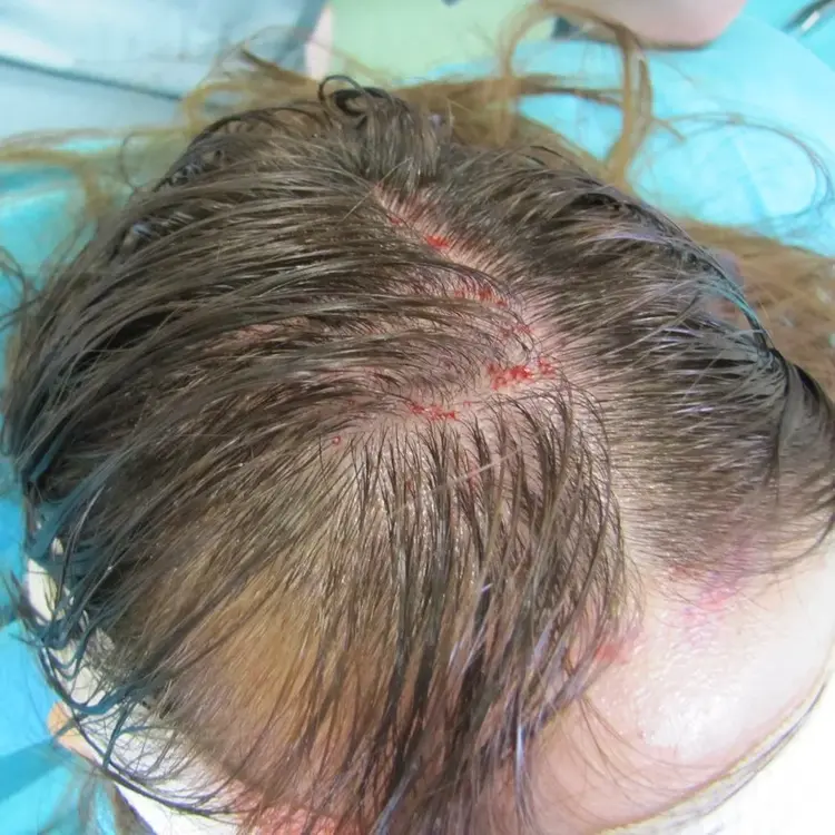 Haartransplantation bei Frauen mit der raschfreien Methode