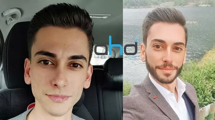 L'aspetto dell'uomo che si rade la barba 6 mesi dopo un trapianto