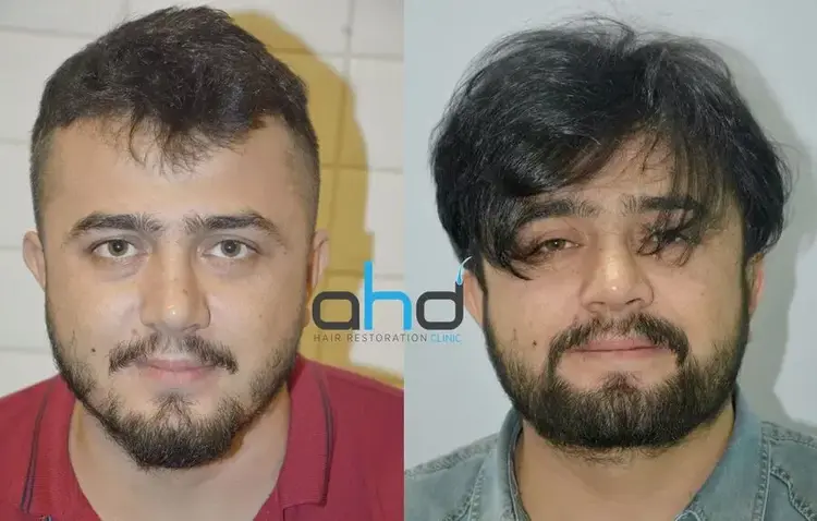 Il paziente che si è sottoposto a un trapianto di barba e baffi ha ottenuto eccellenti risultati.
