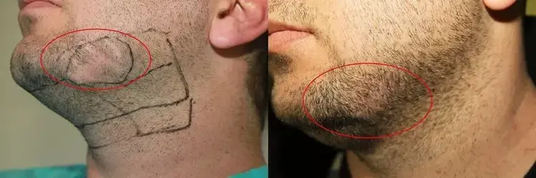 Un trapianto di barba di 200 innesti per la zona cicatrizzata sul viso