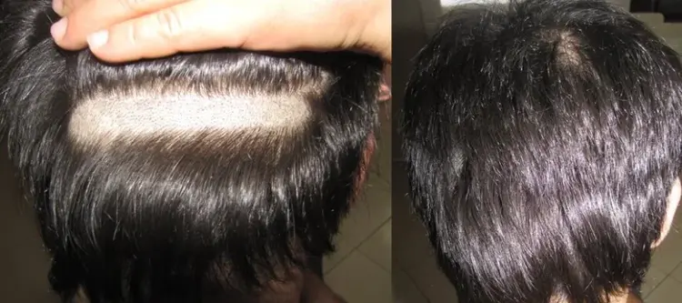 Unrasierte-Haartransplantation