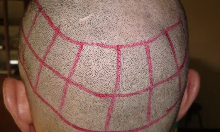 Spenderbereich für Haartransplantation (Haare im Hinterkopfbereich)