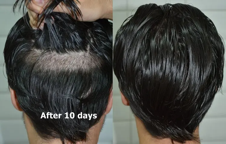 Aspect de la zone donneuse 10 jours après une greffe de cheveux sans rasage