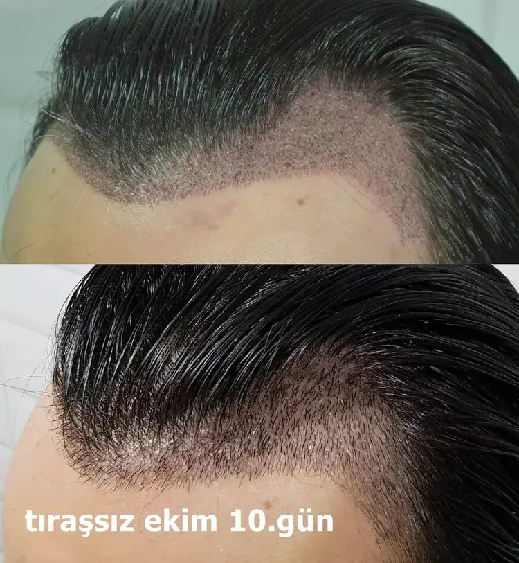 Dans la zone où la plantation sera effectuée par méthode sans rasage, il n'est pas nécessaire de couper les cheveux.