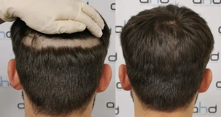 greffe de cheveux sans raser