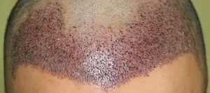 haartransplantatie