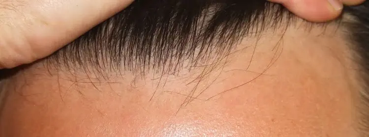 Hoe zou de natuurlijke haarlijn moeten zijn bij een haartransplantatie? Het antwoord staat in de afbeelding