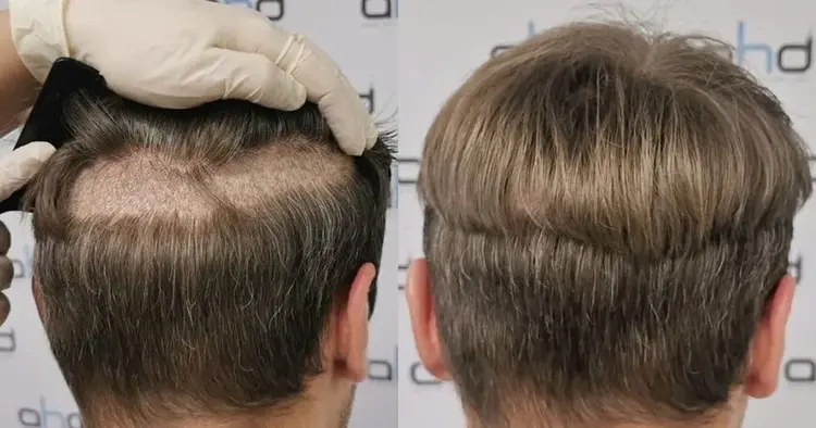 L'apparence après la coupe de cheveux, la plantation et le prélèvement de greffes.