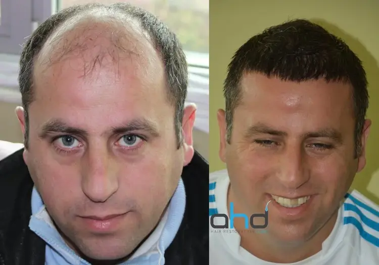 10.000 grafts haartransplantatie en eindelijk een natuurlijke uitstraling.