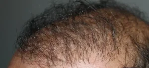 trapianto capelli andato male