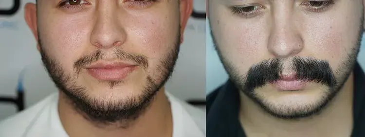 Il paziente che si è sottoposto a un trapianto di barba e baffi ha ottenuto eccellenti risultati.
