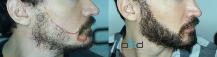 immagine prima e dopo il trapianto della barba