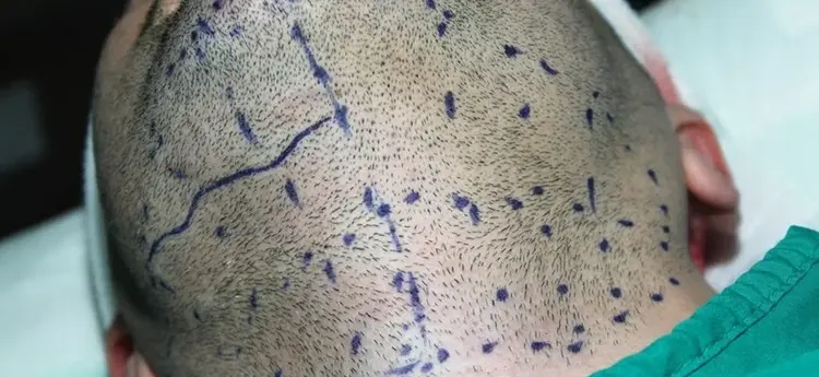 Haartransplantation von Barthaaren auf den Kopf