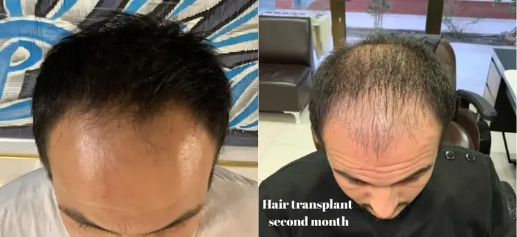 2 months hair transplantation