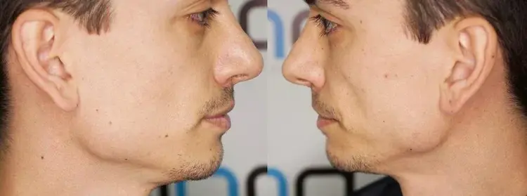 Ein Haartransplantat kann bei einem Mann durchgeführt werden, der überhaupt keinen Bart hat.
