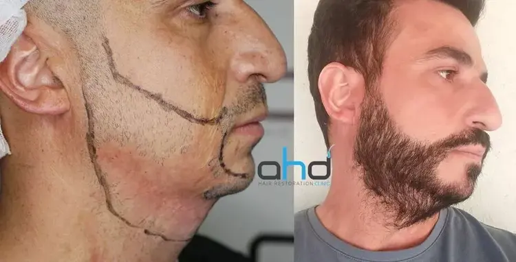 Nach seiner Barttransplantation ist der Mann mit dem verbrannten Gesicht sehr glücklich.