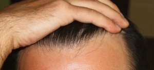 Haartransplantationsergebnis Türkei