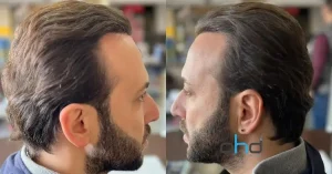 Antes y después del trasplante de cabello