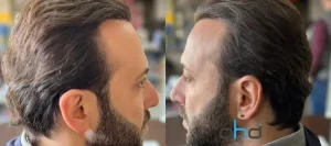 período pós-transplante capilar