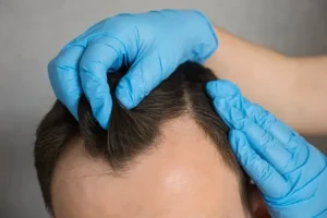 Ödem Haartransplantation