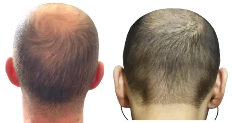 Photos of the donor areas of two men who are not suitable for hair transplantation