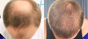 Trapianto di capelli di 5000 innesti