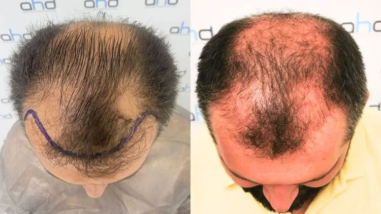Imagen de 3 meses de un hombre antes del trasplante capilar y experimentando pérdida de cabello por efluvio telógeno.


