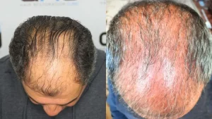 Chute de cheveux post-opératoire pendant 3 mois