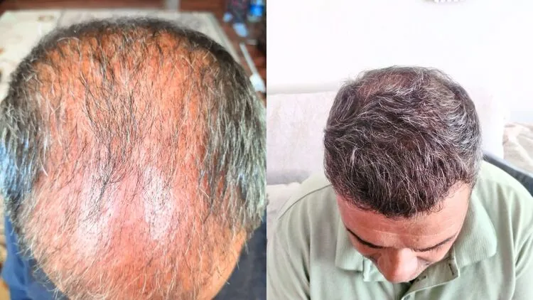3 meses de caída del cabello aguda y 1 año después.

