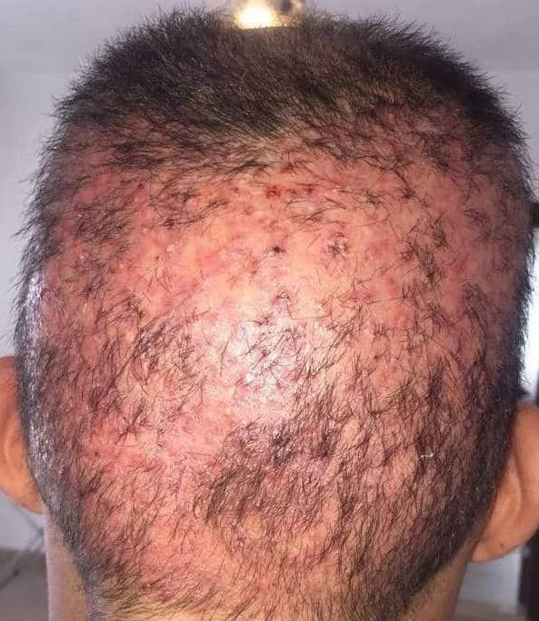 Permanenter Verlust und unästhetisches Erscheinungsbild, verursacht durch eine fehlerhafte Entnahme der Haartransplantate.