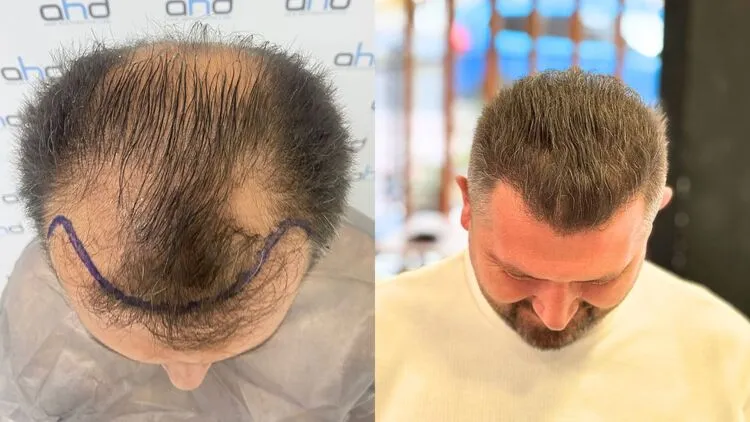 Imagen antes y un año después del trasplante de cabello.

