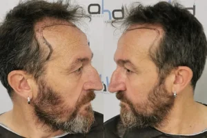 Trasplante de pelo en las entradas