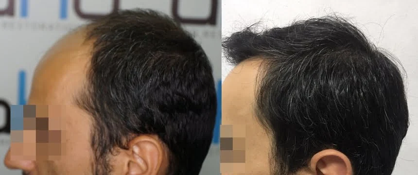 greffe de cheveux tempes